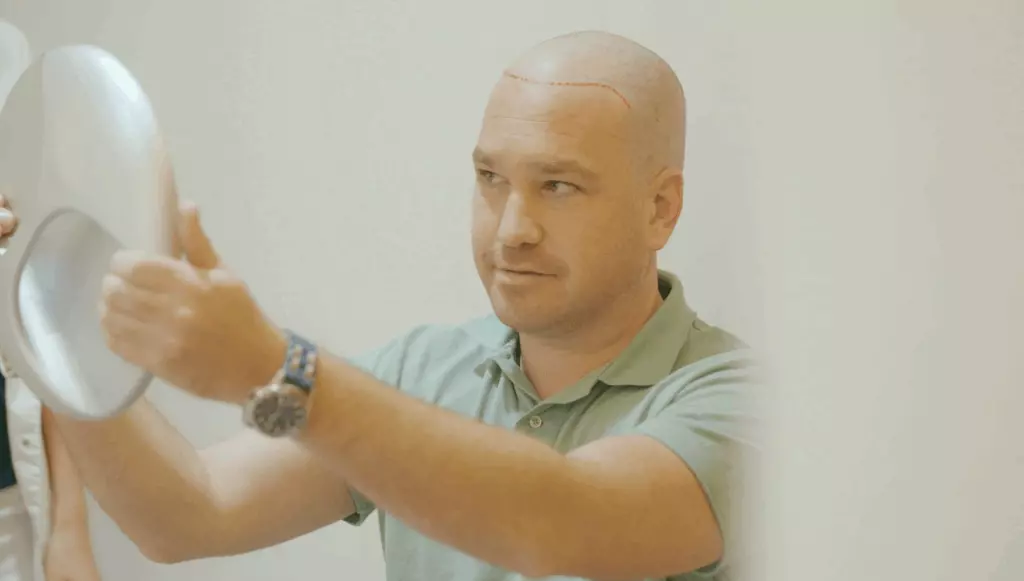 Scalp Micropigmentation