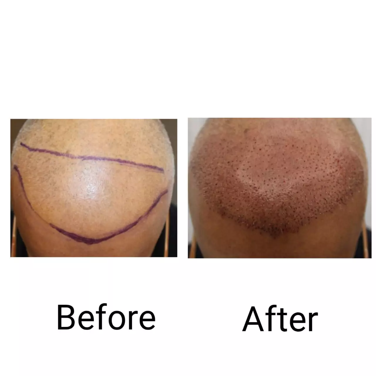 Hair restoration result 1