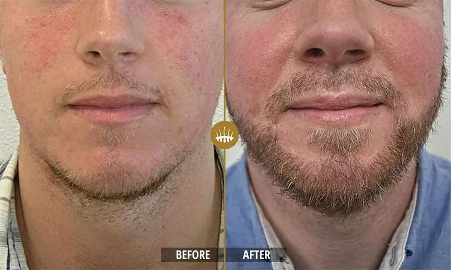 Hair restoration result 10