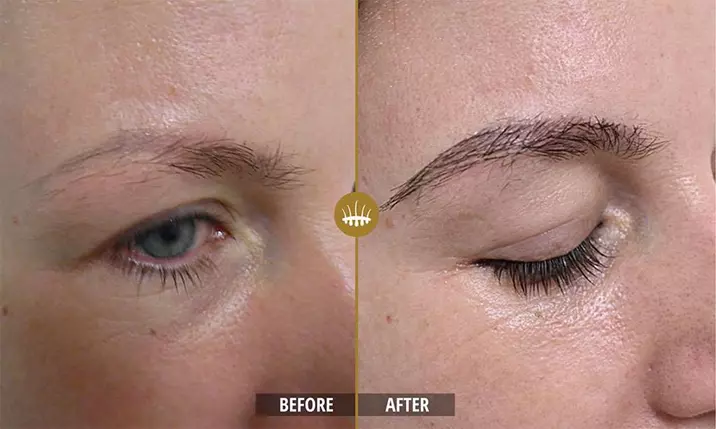 Hair restoration result 11