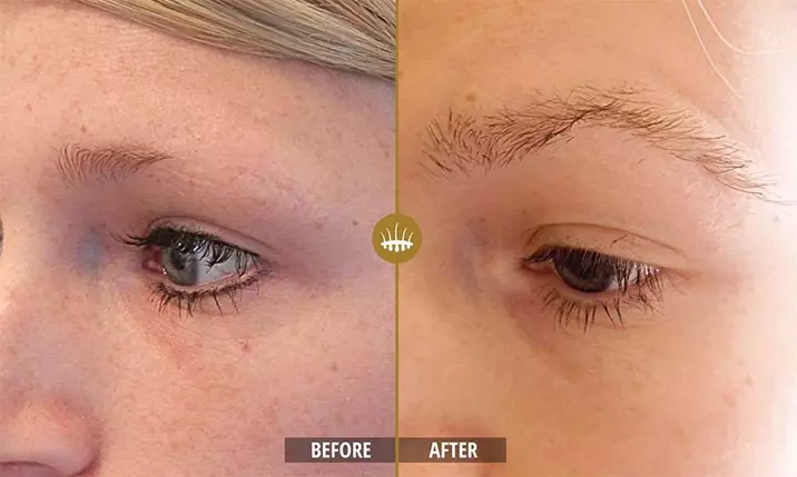 Hair restoration result 12