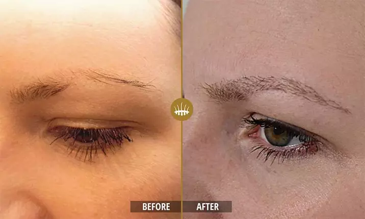 Hair restoration result 13