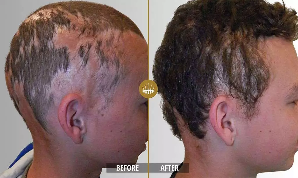 Hair restoration result 18