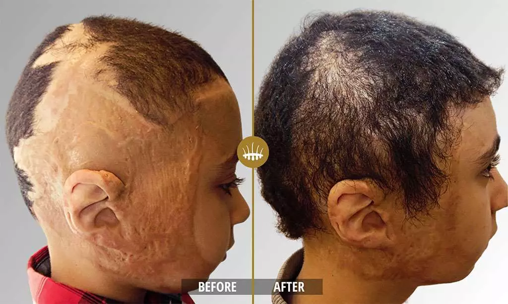 Hair restoration result 19