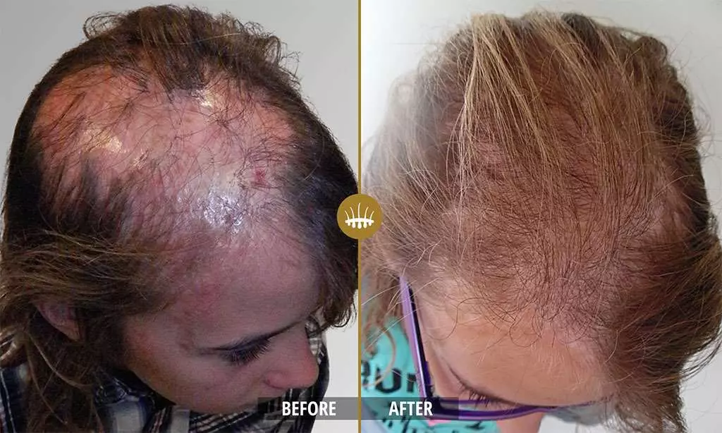 Hair restoration result 21