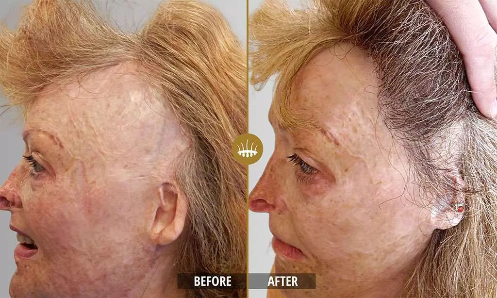 Hair restoration result 22