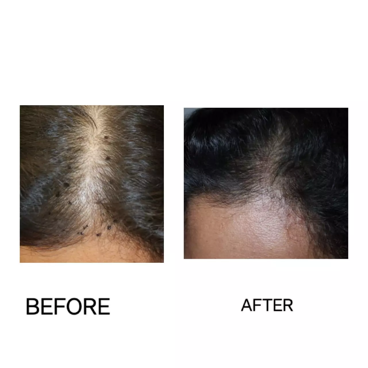 Hair restoration result 3