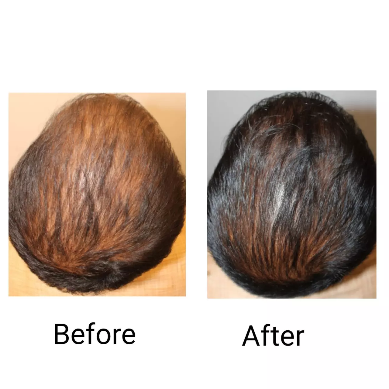 Hair restoration result 4