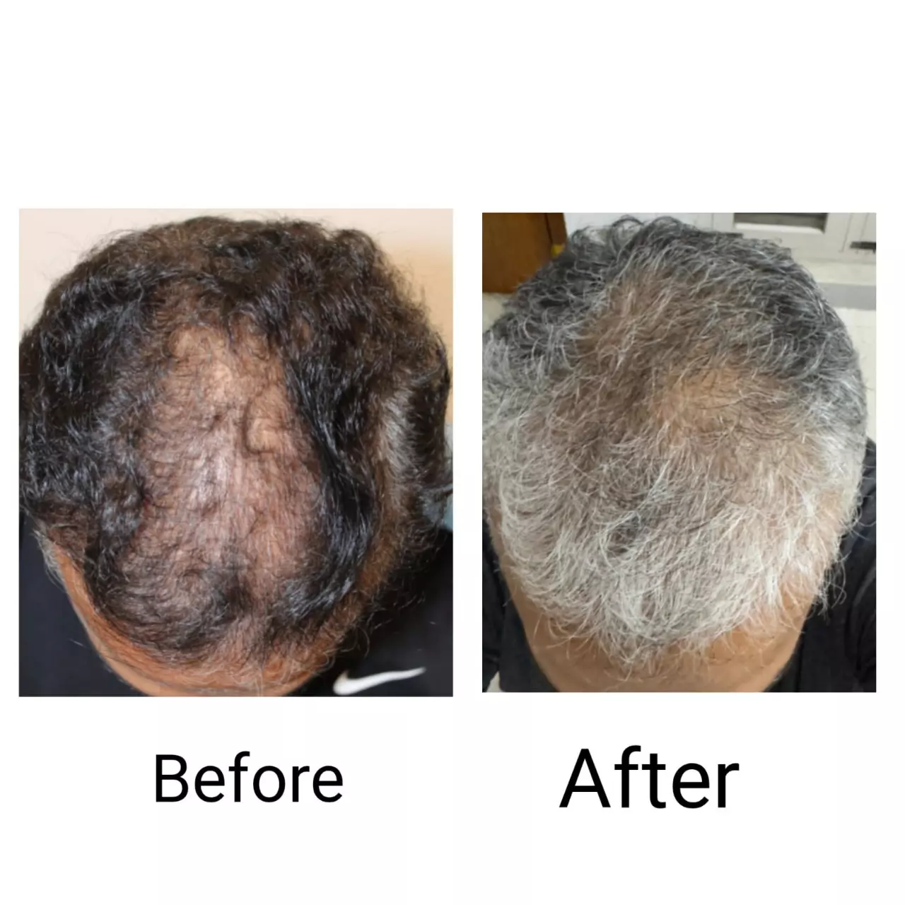 Hair restoration result 5