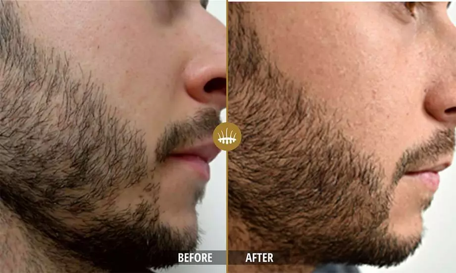 Hair restoration result 8